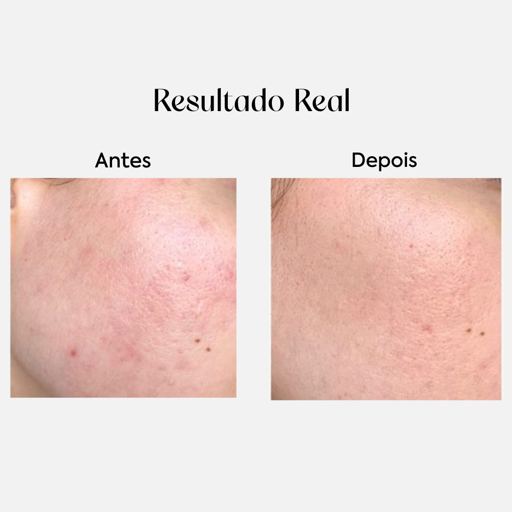 Sérum Controle da Oleosidade com Niacinamida